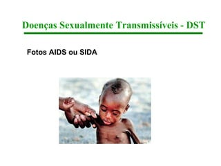 Doenças Sexualmente Transmissíveis - DST

 Fotos AIDS ou SIDA
 