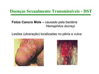 Doenças Sexualmente Transmissíveis - DST

Fotos Cancro Mole – causado pela bactéria
                    Hemaphilus ducreyi

Lesões (ulceração) localizadas no pênis e vulva
 