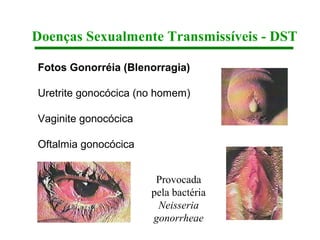 Doenças Sexualmente Transmissíveis - DST

Fotos Gonorréia (Blenorragia)

Uretrite gonocócica (no homem)

Vaginite gonocócica

Oftalmia gonocócica


                       Provocada
                      pela bactéria
                       Neisseria
                      gonorrheae
 