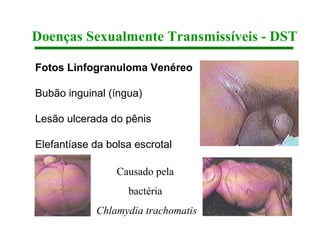 Doenças Sexualmente Transmissíveis - DST

Fotos Linfogranuloma Venéreo

Bubão inguinal (íngua)

Lesão ulcerada do pênis

Elefantíase da bolsa escrotal

                 Causado pela
                   bactéria
            Chlamydia trachomatis
 
