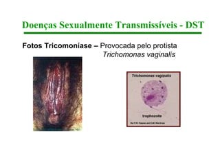 Doenças Sexualmente Transmissíveis - DST

Fotos Tricomoníase – Provocada pelo protista
                     Trichomonas vaginalis
 