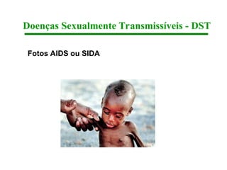 Doenças Sexualmente Transmissíveis - DST
Fotos AIDS ou SIDA
 