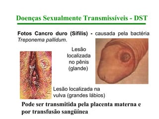 Doenças Sexualmente Transmissíveis - DST
Fotos Cancro duro (Sífilis) - causada pela bactéria
Treponema pallidum.
Lesão localizada na
vulva (grandes lábios)
Lesão
localizada
no pênis
(glande)
Pode ser transmitida pela placenta materna e
por transfusão sangüínea
 