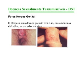 Fotos Herpes Genital
O Herpes é uma doença que não tem cura, causam feridas
doloridas, provocadas por vírus.
Doenças Sexualmente Transmissíveis - DST
 