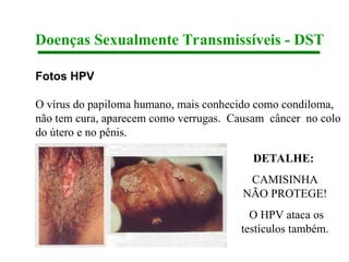 Fotos HPV
O vírus do papiloma humano, mais conhecido como condiloma,
não tem cura, aparecem como verrugas. Causam câncer no colo
do útero e no pênis.
Doenças Sexualmente Transmissíveis - DST
DETALHE:
CAMISINHA
NÃO PROTEGE!
O HPV ataca os
testículos também.
 
