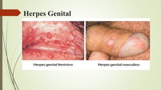 Herpes Genital
 