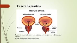 Cancro da próstata
Figura 1:comparação entre uma próstata normal com uma próstata com
cancro.
Fonte: https://www.news-medical.net
 