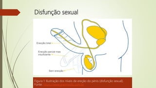 Disfunção sexual
Figura 1: Ilustração dos níveis de ereção do pénis (disfunção sexual).
Fonte: https://www.granmedic.com.br
 