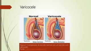 Varicocele
Figura 2: Comparacao do escroto normal com um escroto com
varicocele.
Fonte: https://www.rsaude.com.br
 