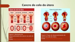 Cancro do colo do útero
Figura 1: Ilustracao do
desenvolvimento do cancro no colo do
útero.
Fonte: https://www.news-medical.net
Figura 2: Fases do desenvolvimento do
cancro no colo do útero.
Fonte: https://www.gineco.com.br
 