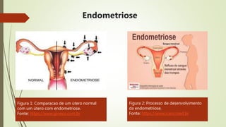 Endometriose
Figura 1: Comparacao de um útero normal
com um útero com endometriose.
Fonte: https://www.gineco.com.br
Figura 2: Processo de desenvolvimento
da endometriose.
Fonte: https://www.icaro.med.br
 