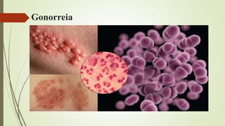 Gonorreia
 