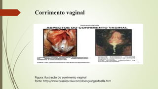 Corrimento vaginal
Figura: ilustração do corrimento vaginal
fonte: http://www.brasilescola.com/doenças/gardnella.htm
 