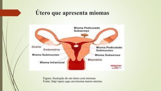 Útero que apresenta miomas
Figura: ilustração de um útero com miomas
Fonte: http//opais.sapo.mz/mioma-tumor-uterino.
 