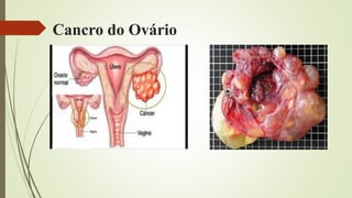 Cancro do Ovário
 
