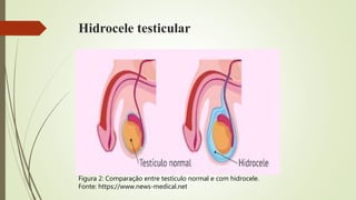 Hidrocele testicular
Figura 2: Comparação entre testículo normal e com hidrocele.
Fonte: https://www.news-medical.net
 