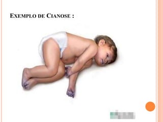 EXEMPLO DE CIANOSE :
 