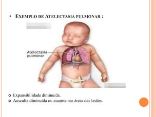 • EXEMPLO DE ATELECTASIA PULMONAR :
 Expansibilidade diminuída.
 Ausculta diminuída ou ausente nas áreas das lesões.
 
