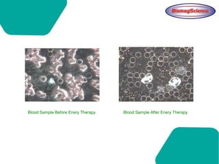 Blood Sample Before Enery Therapy Blood Sample After Enery Therapy
 