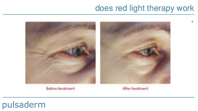 Does Red Light Therapy Work - Pulsaderm