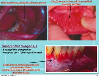 D of keratotic white lesions