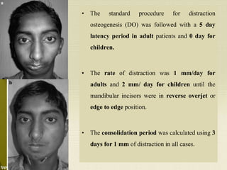 • The standard procedure for distraction
osteogenesis (DO) was followed with a 5 day
latency period in adult patients and 0 day for
children.
• The rate of distraction was 1 mm/day for
adults and 2 mm/ day for children until the
mandibular incisors were in reverse overjet or
edge to edge position.
• The consolidation period was calculated using 3
days for 1 mm of distraction in all cases.
 