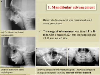 • Bilateral advancement was carried out in all
cases except one.
• The range of advancement was from 15 to 30
mm, with a mean of 22.4 mm on right side and
23.16 mm on left side.
1. Mandibular advancement
(a) Pre distraction orthopantomogram. (b) Post distraction
orthopantomogram showing amount of bone formed.
(b) Post distraction lateral
cephalogram.
(a) Pre distraction lateral
cephalogram.
 