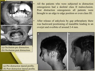 • All the patients who were subjected to distraction
osteogenesis had a skeletal class II malocclusion.
Post distraction osteogenesis all patients were
brought to an edge to edge position or even class III.
• After release of ankylosis by gap arthroplasty there
was backward positioning of mandible leading to an
overjet and overbite of around 2-4 mm.
(a) Pre distraction lateral profile.
(b) Post distraction lateral profile.
(a) Occlusion pre distraction.
(b) Occlusion post distraction.
 
