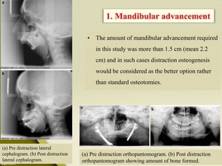 • The amount of mandibular advancement required
in this study was more than 1.5 cm (mean 2.2
cm) and in such cases distraction osteogenesis
would be considered as the better option rather
than standard osteotomies.
1. Mandibular advancement
(a) Pre distraction orthopantomogram. (b) Post distraction
orthopantomogram showing amount of bone formed.
(a) Pre distraction lateral
cephalogram. (b) Post distraction
lateral cephalogram.
 