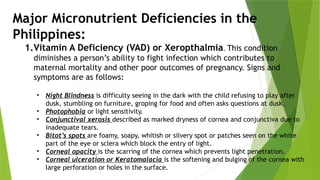 Major Micronutrient Deficiencies in the
Philippines:
1.Vitamin A Deficiency (VAD) or Xeropthalmia. This condition
diminishes a person’s ability to fight infection which contributes to
maternal mortality and other poor outcomes of pregnancy. Signs and
symptoms are as follows:
• Night Blindness is difficulty seeing in the dark with the child refusing to play after
dusk, stumbling on furniture, groping for food and often asks questions at dusk.
• Photophobia or light sensitivity.
• Conjunctival xerosis described as marked dryness of cornea and conjunctiva due to
inadequate tears.
• Bitot’s spots are foamy, soapy, whitish or silvery spot or patches seen on the white
part of the eye or sclera which block the entry of light.
• Corneal opacity is the scarring of the cornea which prevents light penetration.
• Corneal ulceration or Keratomalacia is the softening and bulging of the cornea with
large perforation or holes in the surface.
 