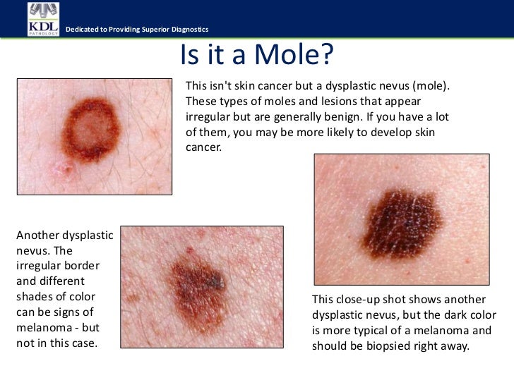 do i have skin cancer why do moles form