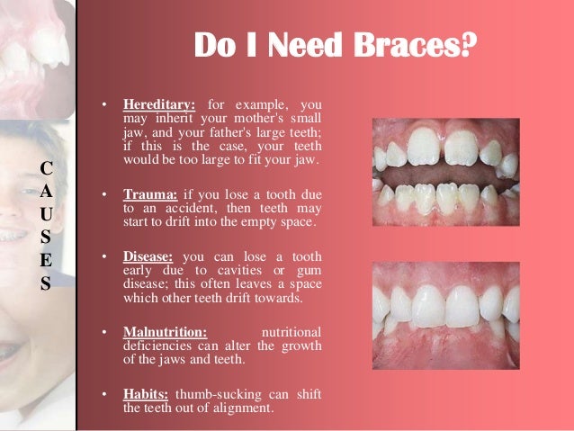 How To Know If You Will Need Braces