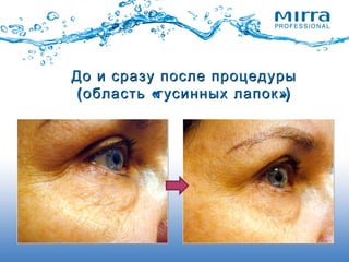 До иДо и сразусразу после процедурыпосле процедуры
( « »)область гусинных лапок( « »)область гусинных лапок
 