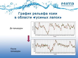 График рельефа кожиГрафик рельефа кожи
вв областобластии « »гусиных лапок« »гусиных лапок
До процедуры
После
процедуры
 