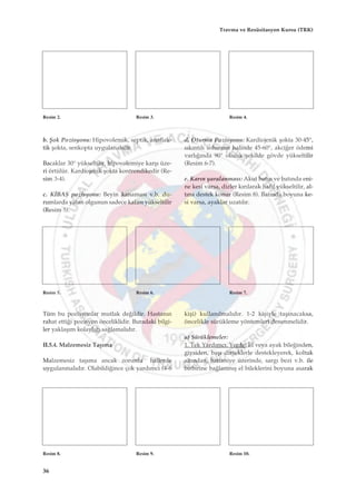 b. ﬁok Pozisyonu: Hipovolemik, septik, anaflak-
tik ﬂokta, senkopta uygulanabilir.
Bacaklar 30° yükseltilir, hipovolemiye karﬂ› üze-
ri örtülür. Kardiojenik ﬂokta kontrendikedir (Re-
sim 3-4).
c. K‹BAS pozisyonu: Beyin kanamas› v.b. du-
rumlarda yatan olgunun sadece kafas› yükseltilir
(Resim 5).
d. Oturma Pozisyonu: Kardiojenik ﬂokta 30-45°,
s›k›nt›l› solunum halinde 45-60°, akci¤er ödemi
varl›¤›nda 90° olacak ﬂekilde gövde yükseltilir
(Resim 6-7).
e. Kar›n yaralanmas›: Akut bat›n ve bat›nda eni-
ne kesi varsa, dizler k›r›larak hafif yükseltilir, al-
t›na destek konur (Resim 8). Bat›nda boyuna ke-
si varsa, ayaklar uzat›l›r.
Resim 2. Resim 3. Resim 4.
Resim 5. Resim 6. Resim 7.
Tüm bu pozisyonlar mutlak de¤ildir. Hastan›n
rahat etti¤i pozisyon önceliklidir. Buradaki bilgi-
ler yaklaﬂ›m kolayl›¤› sa¤lamal›d›r.
II.5.4. Malzemesiz Taﬂ›ma
Malzemesiz taﬂ›ma ancak zorunlu hallerde
uygulanmal›d›r. Olabildi¤ince çok yard›mc› (4-6
kiﬂi) kullan›lmal›d›r. 1-2 kiﬂiyle taﬂ›nacaksa,
öncelikle sürükleme yöntemleri denenmelidir.
a) Sürüklemeler:
1. Tek Yard›mc›, Yerde: El veya ayak bile¤inden,
giysiden, baﬂ› dirseklerle destekleyerek, koltuk
alt›ndan, battaniye üzerinde, sarg› bezi v.b. ile
birbirine ba¤lanm›ﬂ el bileklerini boyuna asarak
Resim 8. Resim 9. Resim 10.
36
Travma ve Resüsitasyon Kursu (TRK)
 