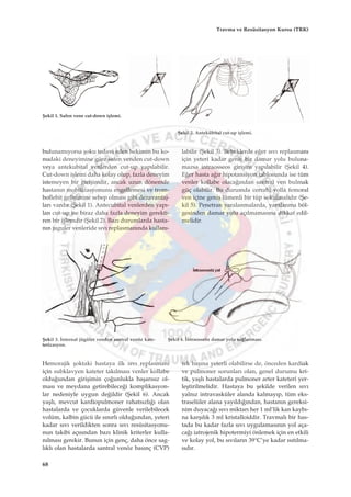 bulunam›yorsa ﬂoku tedavi eden hekimin bu ko-
nudaki deneyimine göre safen venden cut-down
veya antekubital venlerden cut-up yap›labilir.
Cut-down iﬂlemi daha kolay olup, fazla deneyim
istemeyen bir giriﬂimdir, ancak uzun dönemde
hastan›n mobilizasyonunu engellemesi ve trom-
boflebit geliﬂimine sebep olmas› gibi dezavantaj-
lar› vard›r (ﬁekil 1). Antecubital venlerden yap›-
lan cut-up ise biraz daha fazla deneyim gerekti-
ren bir iﬂlemdir (ﬁekil 2). Baz› durumlarda hasta-
n›n juguler venleride s›v› replasman›nda kullan›-
labilir (ﬁekil 3). Bebeklerde e¤er s›v› replasman›
için yeteri kadar geniﬂ bir damar yolu buluna-
mazsa intraosseos giriﬂim yap›labilir (ﬁekil 4).
E¤er hasta a¤›r hipotansiyon tablosunda ise tüm
venler kollabe olaca¤›ndan santral ven bulmak
güç olabilir. Bu durumda cerrahi yolla femoral
ven içine geniﬂ lümenli bir tüp sokulmal›d›r (ﬁe-
kil 5). Penetran yaralanmalarda, yaralanma böl-
gesinden damar yolu aç›lmamas›na dikkat edil-
melidir.
ﬁekil 1. Safen vene cut-down iﬂlemi.
ﬁekil 2. Antekübital cut-up iﬂlemi.
ﬁekil 3. ‹nternal jügüler venden santral venöz kate-
terizasyon.
ﬁekil 4. ‹ntraosseöz damar yolu sa¤lanmas›.
Hemorajik ﬂoktaki hastaya ilk s›v› replasman›
için subklavyen kateter tak›lmas› venler kollabe
oldu¤undan giriﬂimin ço¤unlukla baﬂar›s›z ol-
mas› ve meydana getirebilece¤i komplikasyon-
lar nedeniyle uygun de¤ildir (ﬁekil 6). Ancak
yaﬂl›, mevcut kardiopulmoner rahats›zl›¤› olan
hastalarda ve çocuklarda güvenle verilebilecek
volüm, kalbin gücü ile s›n›rl› oldu¤undan, yeteri
kadar s›v› verildikten sonra s›v› resüsitasyonu-
nun takibi aç›s›ndan baz› klinik kriterler kulla-
n›lmas› gerekir. Bunun için genç, daha önce sag-
l›kl› olan hastalarda santral venöz bas›nç (CVP)
tek baﬂ›na yeterli olabilirse de, önceden kardiak
ve pulmoner sorunlar› olan, genel durumu kri-
tik, yaﬂl› hastalarda pulmoner arter kateteri yer-
leﬂtirilmelidir. Hastaya bu ﬂekilde verilen s›v›
yaln›z intravasküler alanda kalmay›p, tüm eks-
traselüler alana yay›ld›¤›ndan, hastan›n gereksi-
nim duyaca¤› s›v› miktar› her 1 ml’lik kan kayb›-
na karﬂ›l›k 3 ml kristalloiddir. Travmal› bir has-
tada bu kadar fazla s›v› uygulamas›n›n yol aça-
ca¤› iatrojenik hipotermiyi önlemek için en etkili
ve kolay yol, bu s›v›lar›n 39°C’ye kadar ›s›t›lma-
s›d›r.
68
Travma ve Resüsitasyon Kursu (TRK)
 
