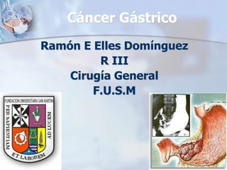 Cáncer Gástrico
Ramón E Elles Domínguez
R III
Cirugía General
F.U.S.M
 