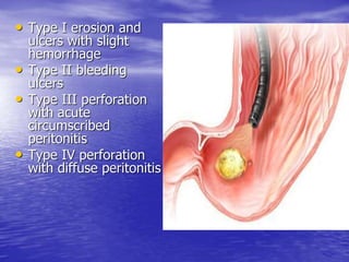 • Type I erosion and
ulcers with slight
hemorrhage
• Type II bleeding
ulcers
• Type III perforation
with acute
circumscribed
peritonitis
• Type IV perforation
with diffuse peritonitis
 