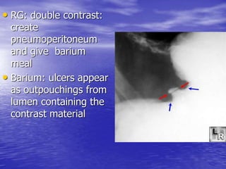 • RG: double contrast:
create
pneumoperitoneum
and give barium
meal
• Barium: ulcers appear
as outpouchings from
lumen containing the
contrast material
 