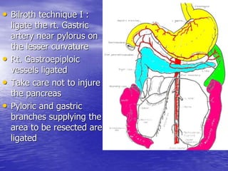 • Bilroth technique I :
ligate the rt. Gastric
artery near pylorus on
the lesser curvature
• Rt. Gastroepiploic
vessels ligated
• Take care not to injure
the pancreas
• Pyloric and gastric
branches supplying the
area to be resected are
ligated
 
