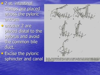 • 2 st. intestinal
clamps are placed
across the pyloric
antrum
• another 2 are
placed distal to the
pylorus and avoid
the common bile
duct.
• Excise the pyloric
sphincter and canal
 