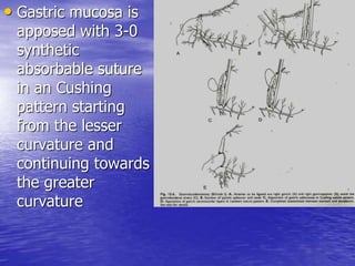 • Gastric mucosa is
apposed with 3-0
synthetic
absorbable suture
in an Cushing
pattern starting
from the lesser
curvature and
continuing towards
the greater
curvature
 