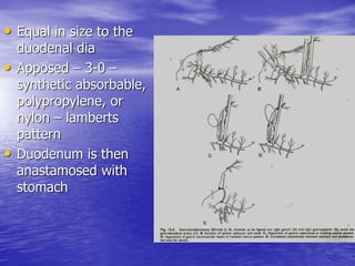 • Equal in size to the
duodenal dia
• Apposed – 3-0 –
synthetic absorbable,
polypropylene, or
nylon – lamberts
pattern
• Duodenum is then
anastamosed with
stomach
 