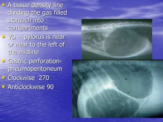 • A tissue density line
dividing the gas filled
stomach into
compartments
• VD - pylorus is near
or near to the left of
the midline
• Gastric perforation-
pneumoperitoneum
• Clockwise 270
• Anticlockwise 90
 