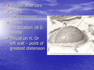 • Preoperative care
• Gastric
decompression
• Needle
trocarization 18 G
needle
• Thrust on rt. Or
left wall – point of
greatest distension
 