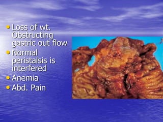• Loss of wt.
Obstructing
gastric out flow
• Normal
peristalsis is
interfered
• Anemia
• Abd. Pain
 