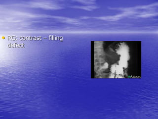 • RG: contrast – filling
defect
 