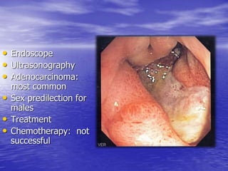 • Endoscope
• Ultrasonography
• Adenocarcinoma:
most common
• Sex predilection for
males
• Treatment
• Chemotherapy: not
successful
 