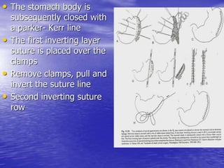 • The stomach body is
subsequently closed with
a parker- Kerr line
• The first inverting layer
suture is placed over the
clamps
• Remove clamps, pull and
invert the suture line
• Second inverting suture
row
 