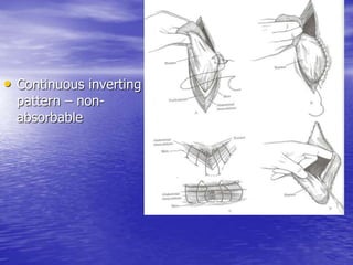 • Continuous inverting
pattern – non-
absorbable
 